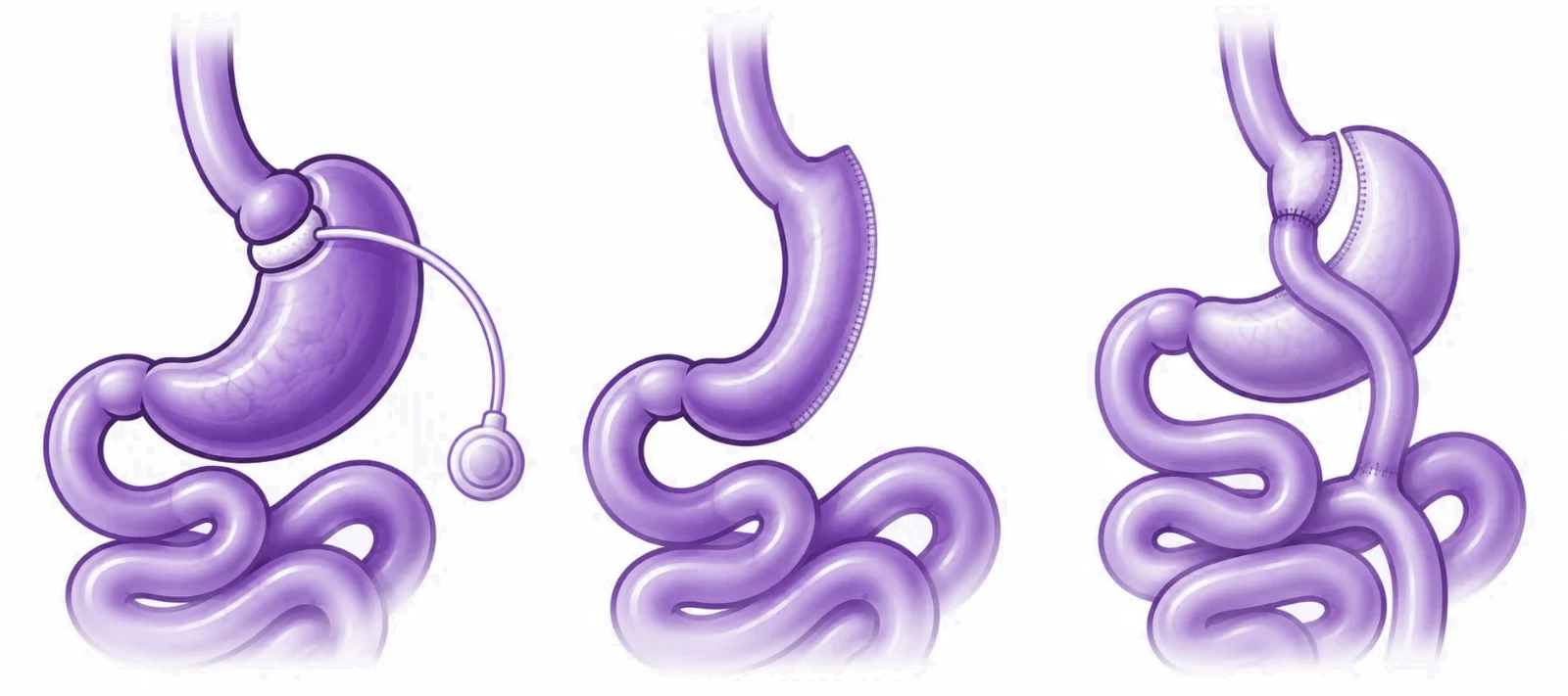 Schéma comparatif : anneau gastrique, sleeve gastrectomie et bypass gastrique.