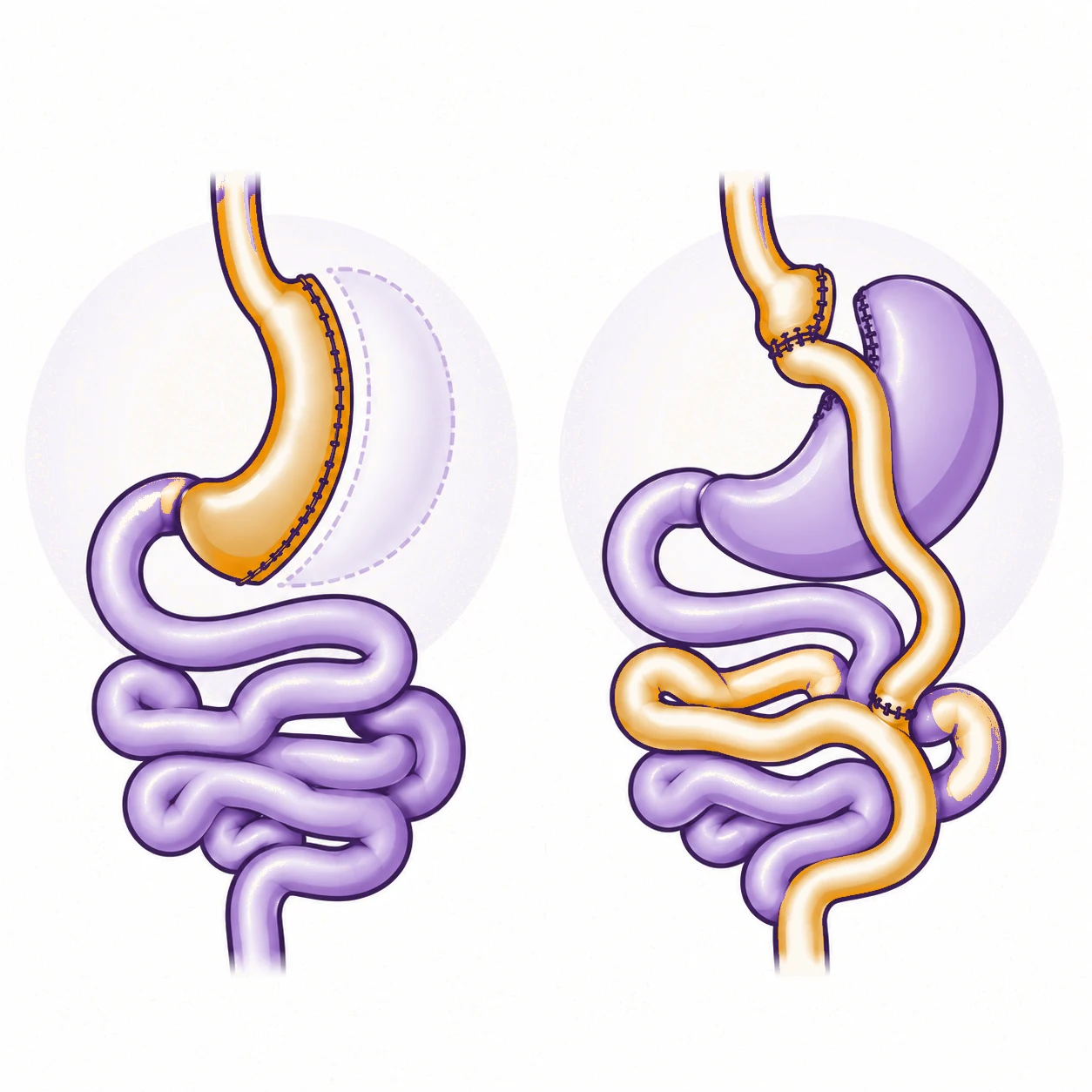 Schéma comparatif : sleeve gastrectomie à gauche, bypass gastrique à droite ; le trajet des aliments est en ocre.